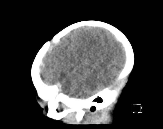File:Bilateral subdural hemorrhage and parietal skull fracture (Radiopaedia 26058-26192 C 4).png