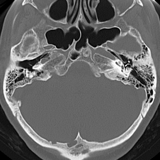 File:Bilateral tympanoplasty (Radiopaedia 16947-16664 Axial bone window 15).jpg