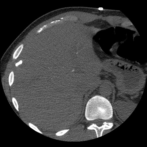 Bile leak from liver traumatic laceration (Radiopaedia 63463-72077 Axial Biliscopin 27).jpg