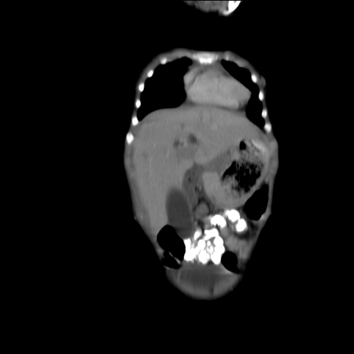 File:Biliary tract embryonal rhabdomyosarcoma (Radiopaedia 51815-57648 B 6).jpg