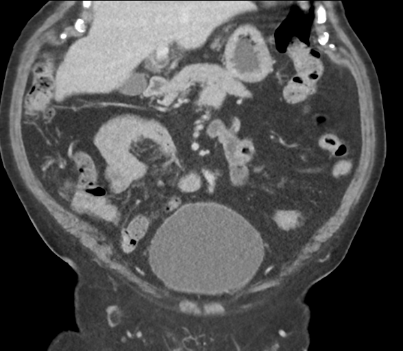 Bladder papillary urothelial carcinoma (Radiopaedia 48119-52951 C 28).png
