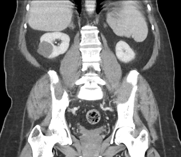 Bladder papillary urothelial carcinoma (Radiopaedia 48119-52951 C 45).png