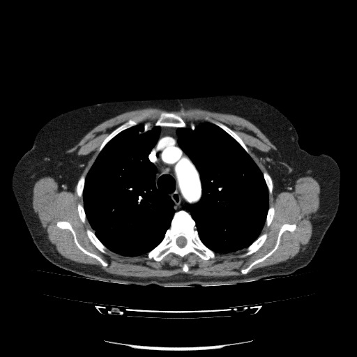 File:Bladder tumor detected on trauma CT (Radiopaedia 51809-57609 A 31).jpg