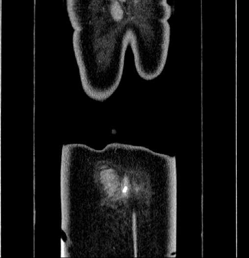 File:Blind-ending branch of a bifid ureter (Radiopaedia 61159-69048 F 71).jpg