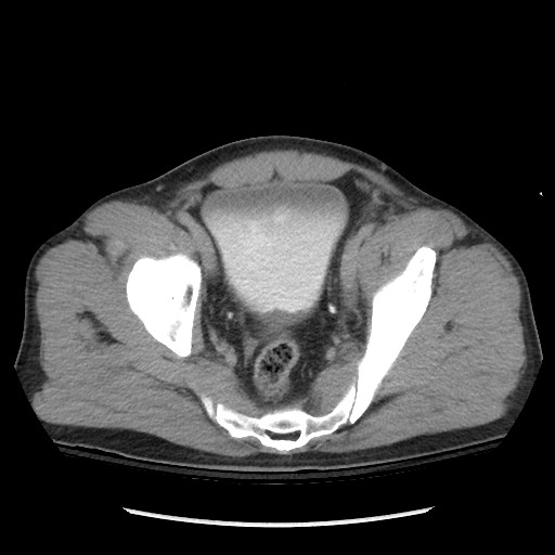 Blunt abdominal trauma with solid organ and musculoskelatal injury with active extravasation (Radiopaedia 68364-77895 Axial C+ delayed 120).jpg
