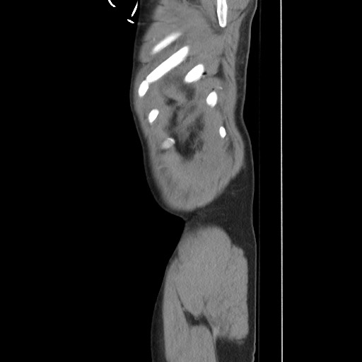 Blunt abdominal trauma with solid organ and musculoskelatal injury with active extravasation (Radiopaedia 68364-77895 C 133).jpg