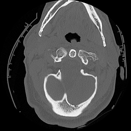 File:Blunt cerebrovascular injury (Radiopaedia 53682-59743 Axial bone window 16).png