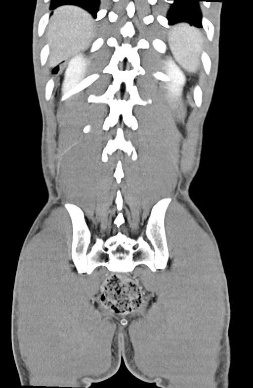 Blunt injury to the small bowel (Radiopaedia 74953-85987 B 80).jpg