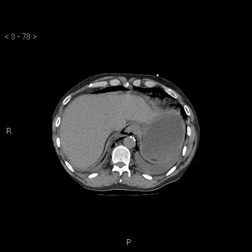 Boerhaave syndrome (Radiopaedia 27683-27897 Axial non-contrast 78).jpg