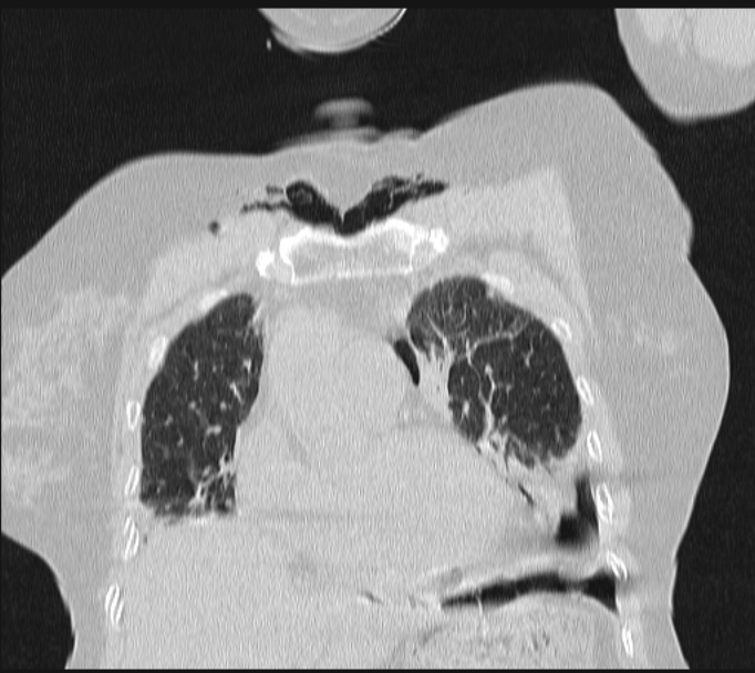 Boerhaave syndrome (Radiopaedia 45644-49799 Coronal lung window 21).jpg