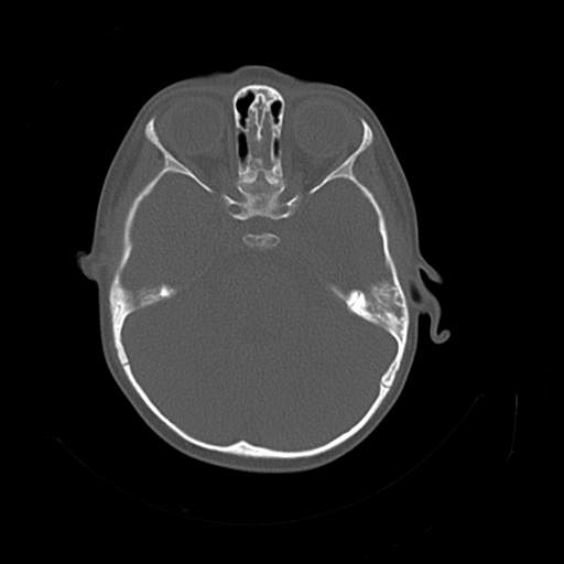 File:Bony atresia of the right external auditory canal (Radiopaedia 27916-28156 Axial bone window 11).jpg