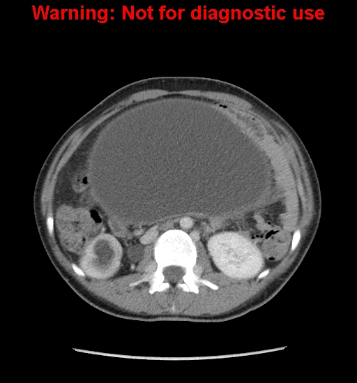 Borderline mucinous cystadenoma of ovary (Radiopaedia 25586-25767 A 15).jpg