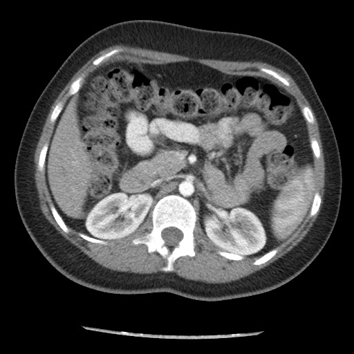 File:Borderline mucinous tumor (ovary) (Radiopaedia 78228-90808 A 53).jpg