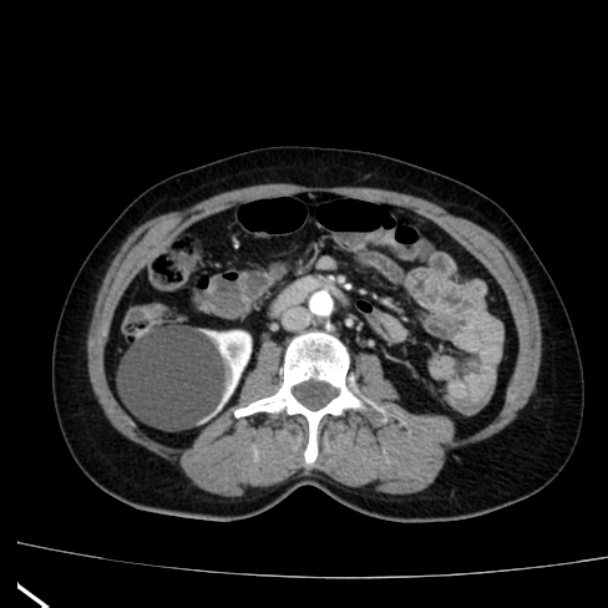 Bosniak renal cyst - type I (Radiopaedia 27479-27675 renal cortical phase 43).jpg