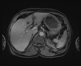 Bouveret syndrome (Radiopaedia 61017-68856 Axial T1 C+ fat sat 25).jpg