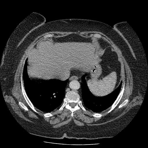 Bovine aortic arch - right internal mammary vein drains into the superior vena cava (Radiopaedia 63296-71875 A 129).jpg