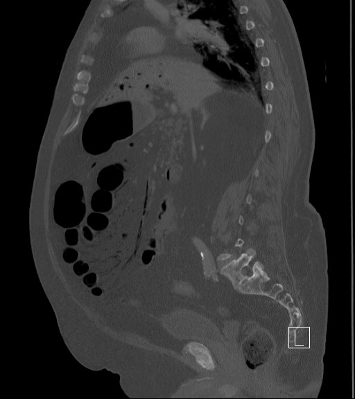Bowel ischemia secondary to SMA occlusion with extensive portomesenteric venous gas (Radiopaedia 54656-60871 Sagittal bone window 63).jpg