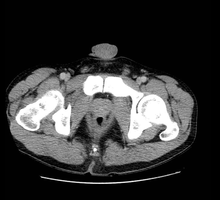 Bowel obstruction from colon carcinoma (Radiopaedia 22995-23028 A 86).jpg