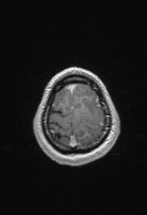 Brain abscess with ventriculitis (Radiopaedia 85703-101495 Axial T1 C+ 151).jpg