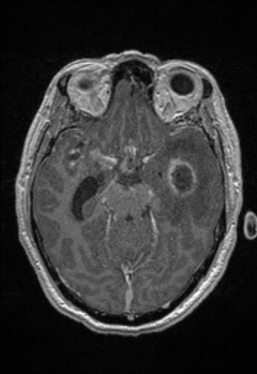 Brain abscess with ventriculitis (Radiopaedia 85703-101495 Axial T1 C+ 72).jpg