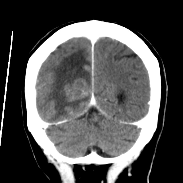 File:Brain metastases from breast cancer (Radiopaedia 23178-23231 D 31).jpg