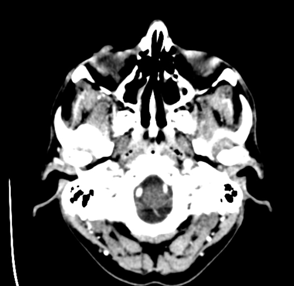 File:Brain metastases from lung cancer (Radiopaedia 24480-24781 Axial C+ delayed 2).jpg