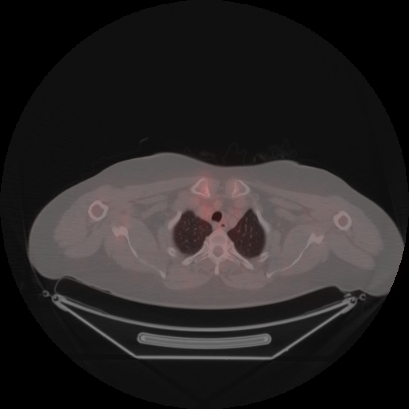Brain metastasis (Radiopaedia 89847-106962 Axial lung window 5).jpg