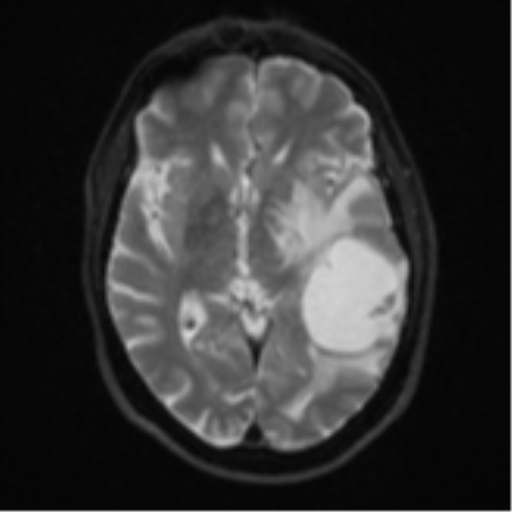 Brain metastasis (large cystic mass) (Radiopaedia 47497-52107 Axial DWI 13).png