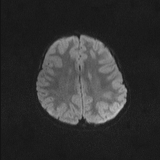 Brainstem glioma (Radiopaedia 67531-76922 Axial DWI 40).jpg