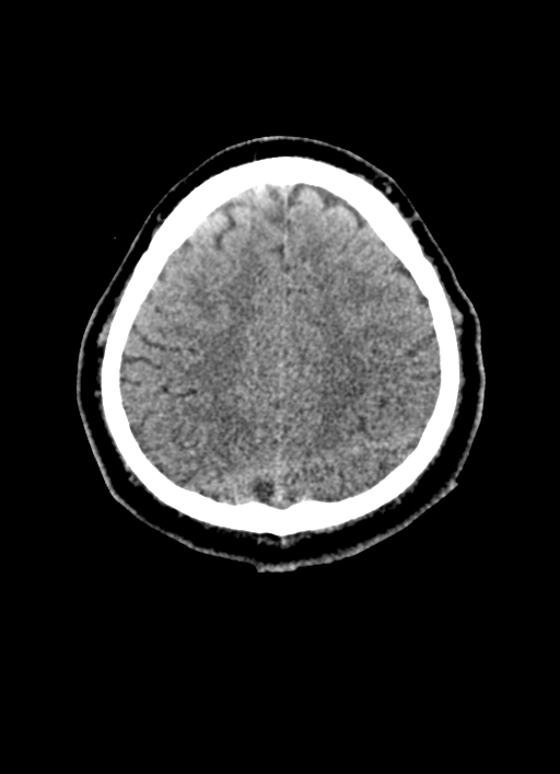 Brainstem hemorrhage (Radiopaedia 81294-94976 Axial non-contrast 18).jpg