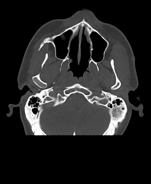 Branchial cleft cyst (Radiopaedia 31167-31875 Axial bone window 11).jpg