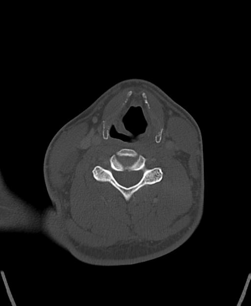 Branchial cleft cyst (Radiopaedia 31167-31875 Axial bone window 44).jpg