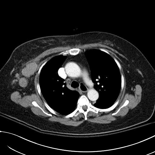 File:Breast carcinoma with pathological hip fracture (Radiopaedia 60314-67974 A 20).jpg