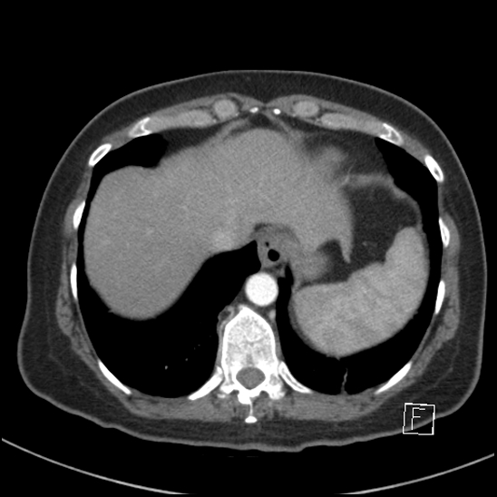 Breast metastases from renal cell cancer (Radiopaedia 79220-92225 A 76).jpg