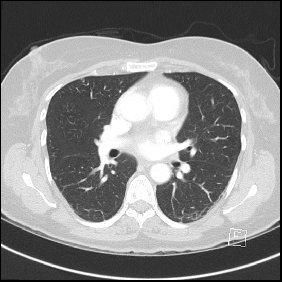 Breast metastases from renal cell cancer (Radiopaedia 79220-92225 Axial lung window 42).jpg