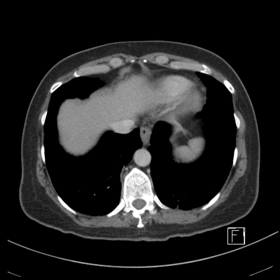Breast metastases from renal cell cancer (Radiopaedia 79220-92225 C 7).jpg
