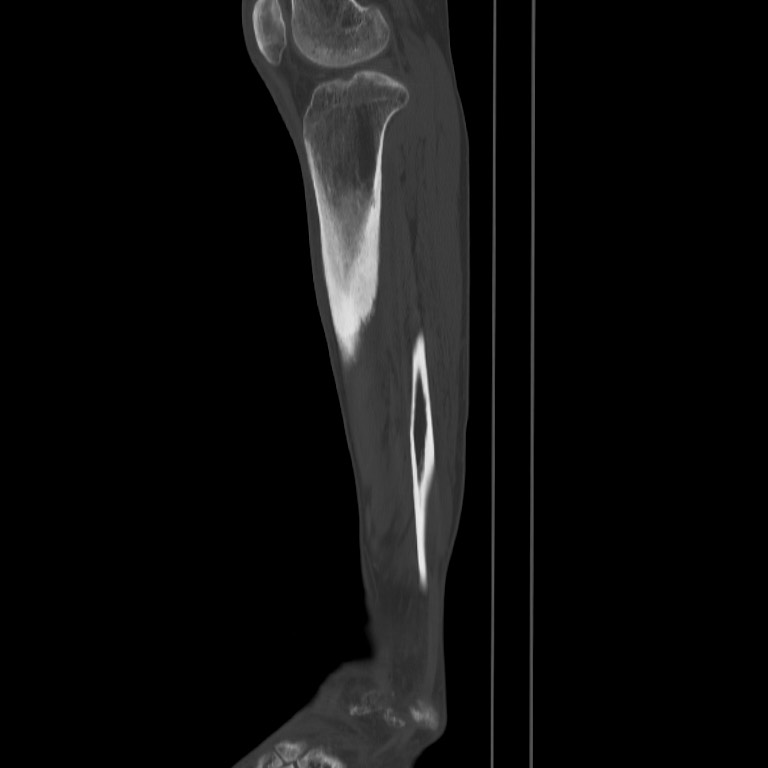 Brodie abscess - tibia (Radiopaedia 66028-75204 Sagittal bone window 52).jpg