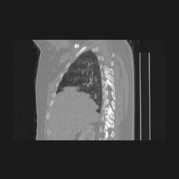Bronchial atresia (Radiopaedia 60685-68439 Sagittal lung window 24).jpg