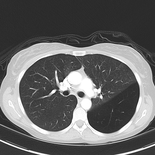 Bronchial atresia (Radiopaedia 73677-84470 Axial lung window 26).jpg