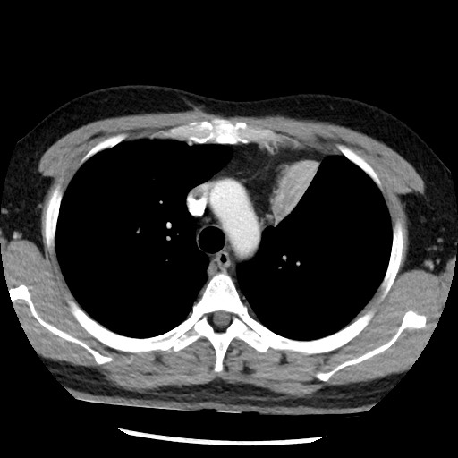 File:Bronchial carcinoid tumor (Radiopaedia 67377-76764 A 21).jpg