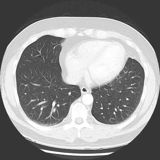 Bronchial carcinoid tumor (Radiopaedia 67377-76764 Axial lung window 44).jpg