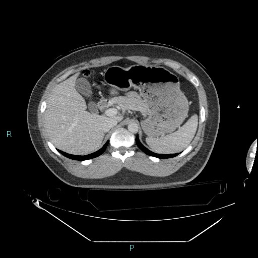 Bronchial carcinoid tumor (Radiopaedia 78272-90870 C 121).jpg