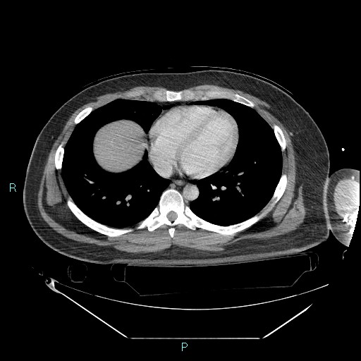 Bronchial carcinoid tumor (Radiopaedia 78272-90870 C 80).jpg