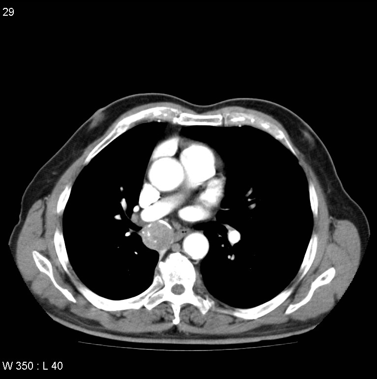 Bronchial carcinoid tumor with right lower lobe collapse (Radiopaedia 29060-29422 A 28).jpg