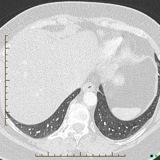 File:Bronchial diverticula (Radiopaedia 79512-92676 Axial lung window 176).jpg