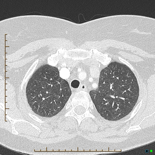 Bronchial diverticula (Radiopaedia 79512-92676 Axial lung window 28).jpg