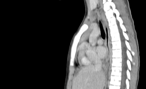 Bronchial mucoepidermoid carcinoma (Radiopaedia 57023-63895 Sagittal 117).jpg