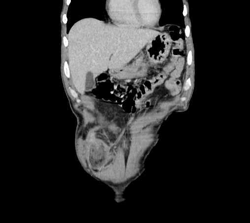 File:Bronchiectasis in Crohn disease (Radiopaedia 60311-67977 C 14).jpg