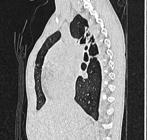 File:Bronchiolitis obliterans (Radiopaedia 71538-81897 Sagittal lung window 27).jpg