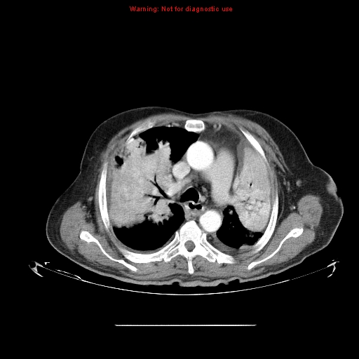 File:Bronchioloalveolar carcinoma (Radiopaedia 9272-9955 A 11).jpg